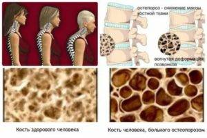 Топ-10 народных средств для лечения остеопороза