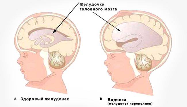 Лечение наружной гидроцефалии головного мозга у взрослых