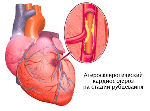 Атеросклеротический кардиосклероз: что это такое, причины, лечение