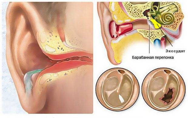 Хронический адгезивный средний отит или болезнь среднего уха: что это такое, симптомы и лечение