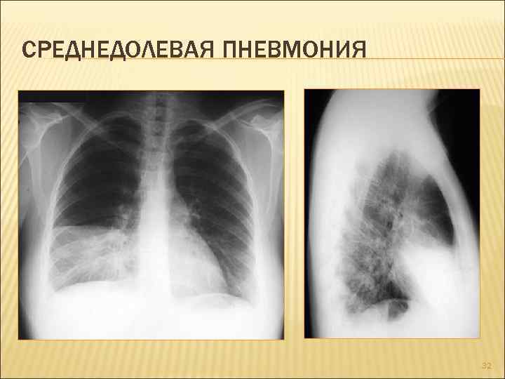 Внебольничная пневмония: что это, причины, симптомы