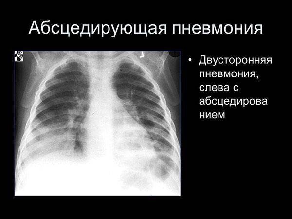 Первый признак воспаления лёгких: как обнаружить?
