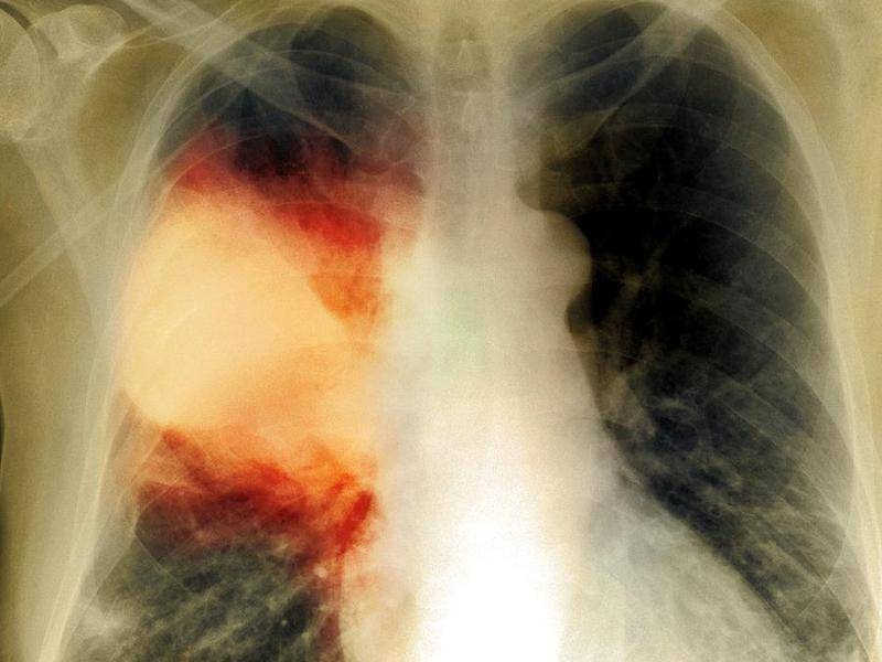 Пневмония на рентгене у детей и взрослых: рентгенологическая картина, признаки воспаления легких на снимке, описание и фото рентгенограммы