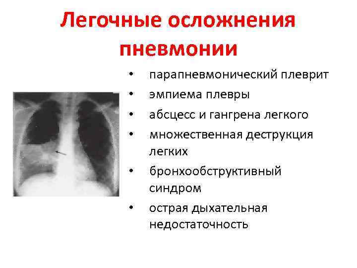 Осложнения пневмонии