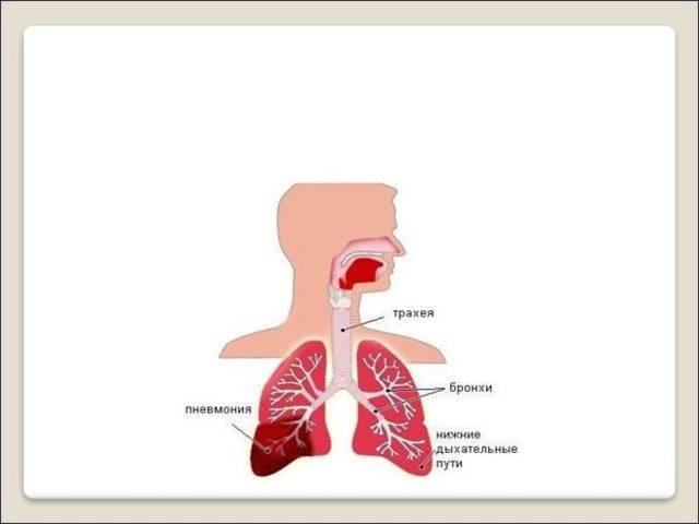 Правосторонняя пневмония у детей: признаки, диагностика, лечение