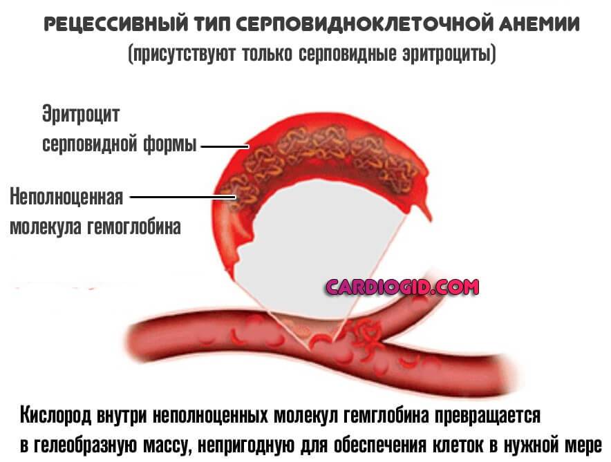 Серповидноклеточная анемия – причины, симптомы, лечение. :: polismed.com