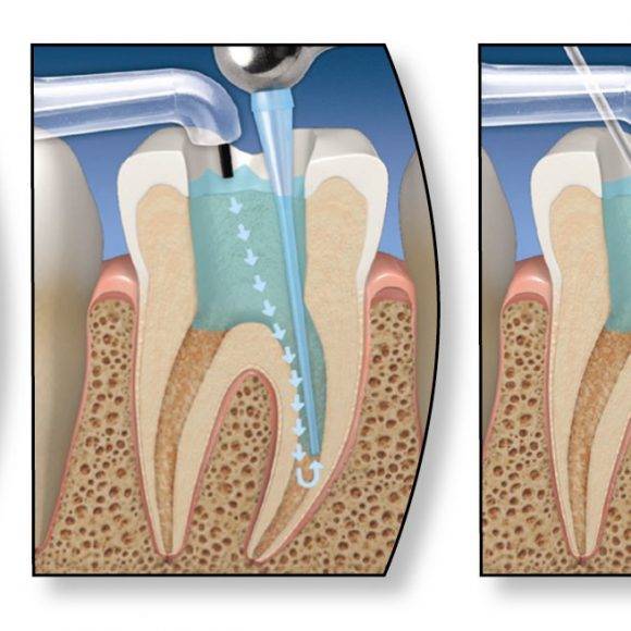 Депульпирование зуба: что это такое, что значит, сколько прослужит, последствия операции