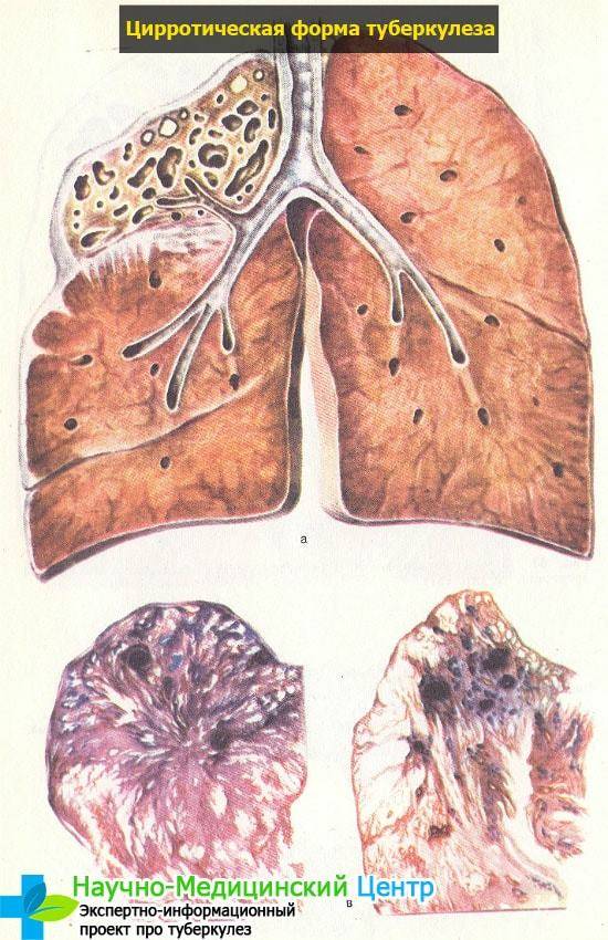 Симптомы туберкулеза легких у взрослых, диагностика и принципы лечения