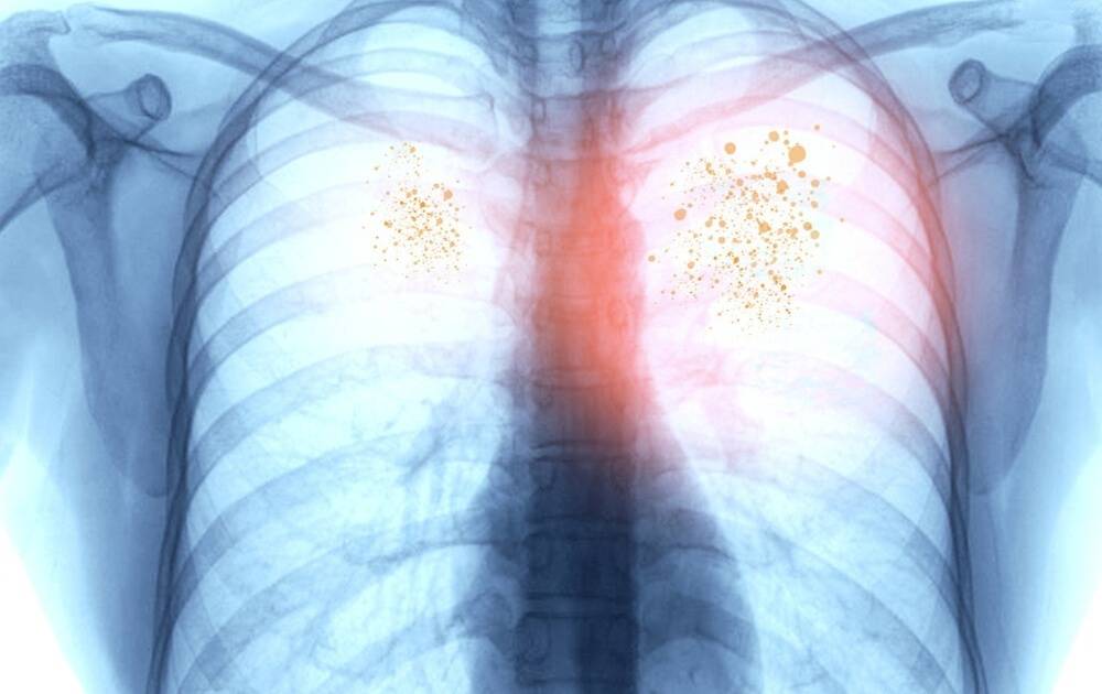 Как правильно распознать и вовремя вылечить инфекционную пневмонию