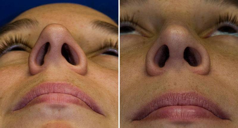 Операции по исправлению перегородки носа: хирургическая, лазером