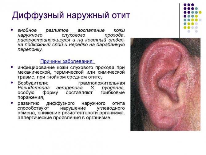 Чем лечить наружный отит уха у взрослых