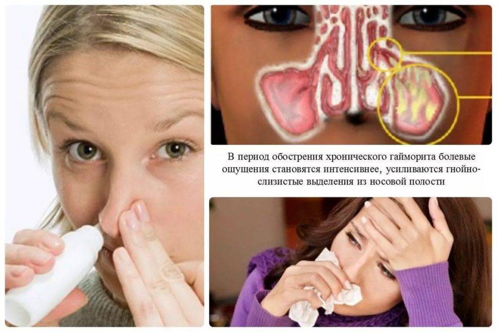 Одонтогенный гайморит: симптомы и лечение зубного гайморита