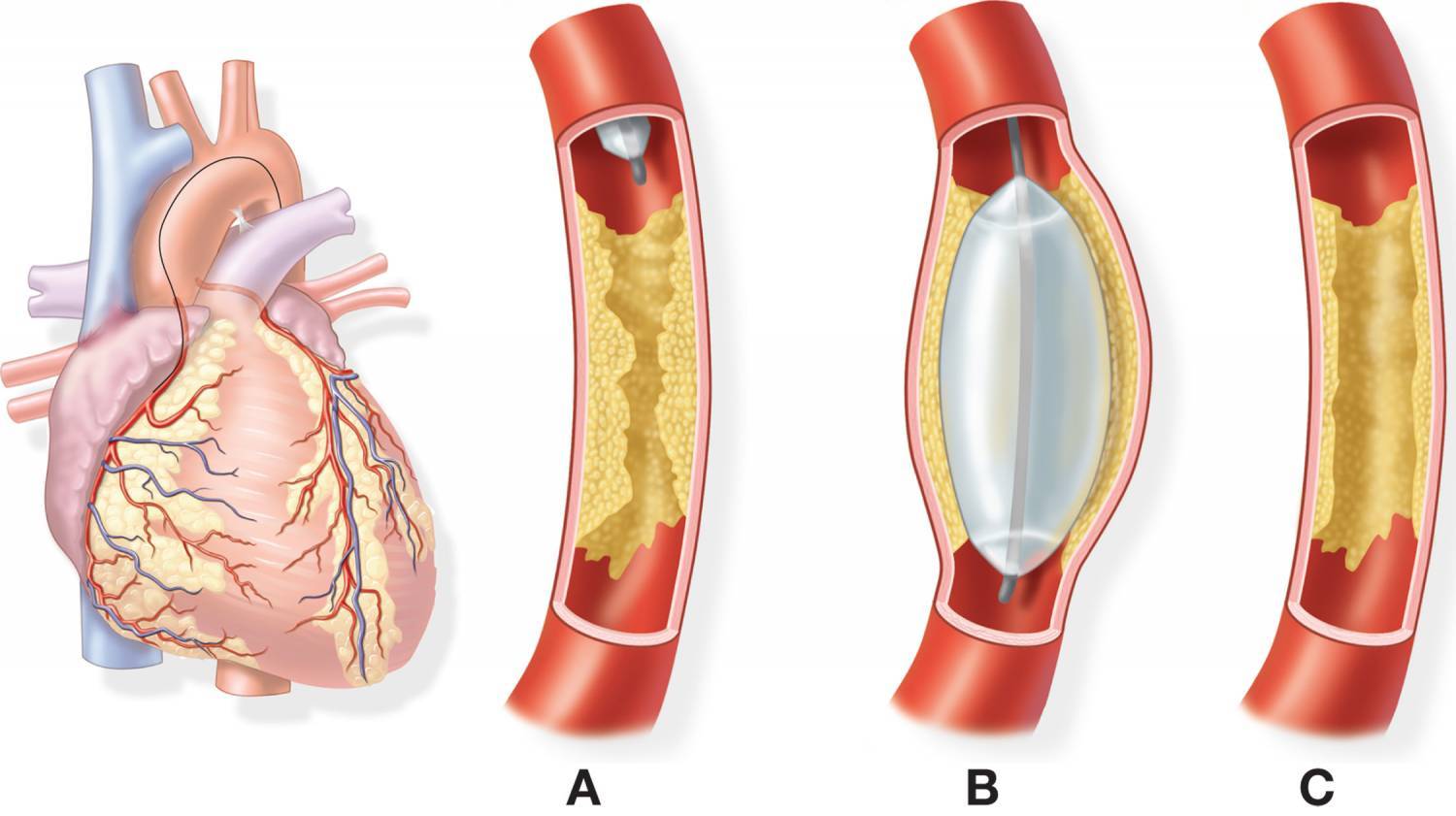 Реабилитация после стентирования сосудов сердца: диета, спорт и изменения в жизни после стентирования
