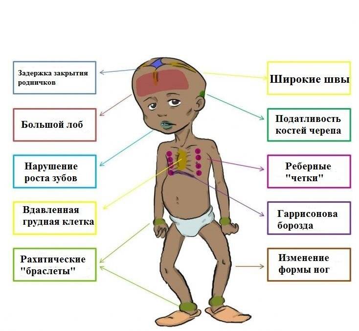Рахит у детей: симптомы, лечение и профилактика рахита у детей