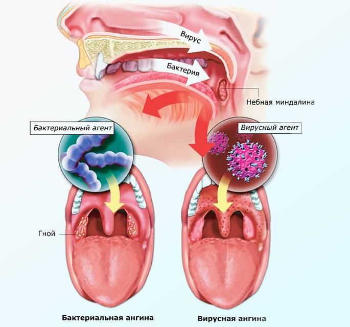 Фолликулярная ангина - симптомы и лечение антибиотиками