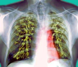 Заразна ли пневмония для окружающих детей – сколько дней опасно воспаление легких