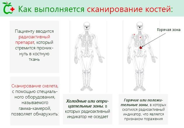 Сцинтиграфия костей скелета: подготовка, проведение и цена обследования
