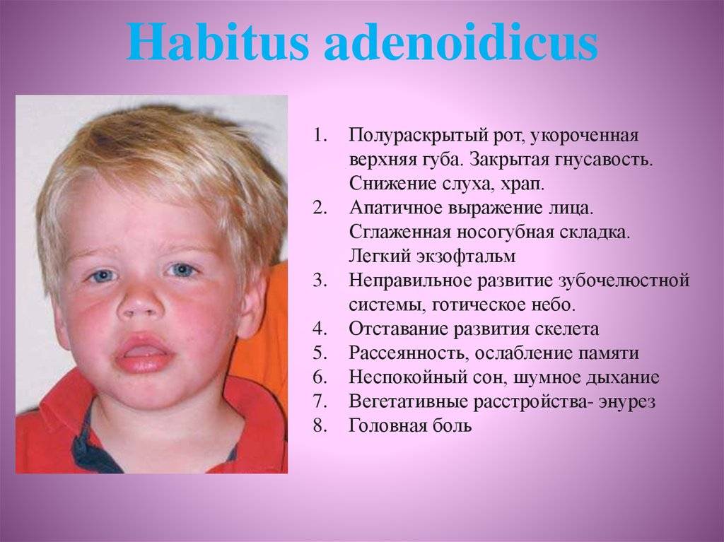 Аденоиды - симптомы: аденоидный тип лица у ребенка, признаки воспаления у детей, причины увеличенных в носоглотке