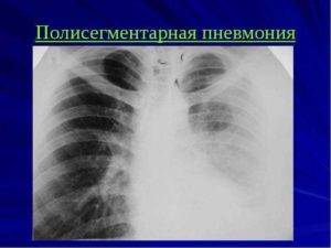 Двусторонняя полисегментарная пневмония у взрослых и детей, внебольничная, лечение, что это, причины, мкб 10