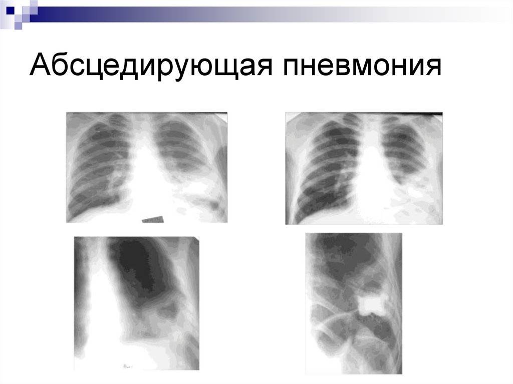 Абсцедирующая пневмония: симптомы, лечение pulmono.ru
абсцедирующая пневмония: симптомы, лечение
