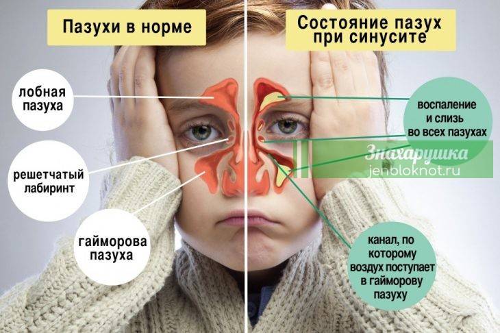 Синусит у детей: признаки и лечение / mama66.ru