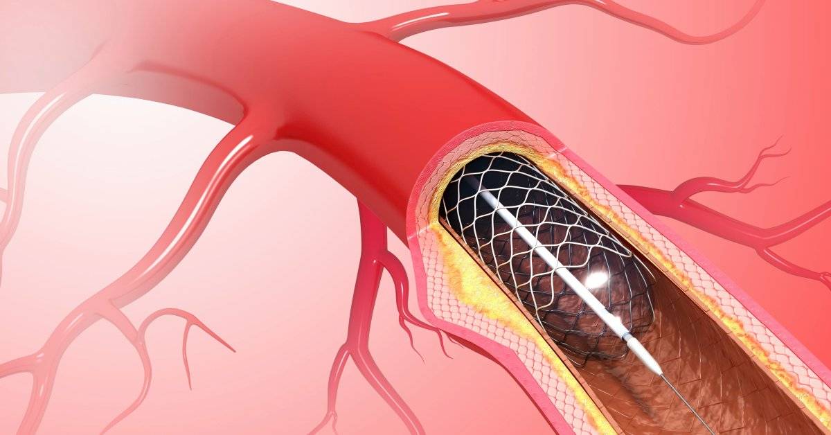 Шунтирование и стентирование сосудов сердца – в чем разница, что лучше и когда делают