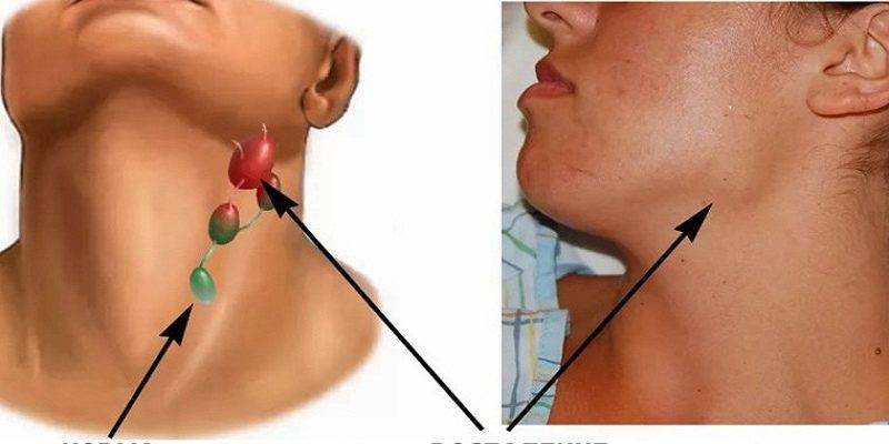 Воспаление лимфоузлов за ухом: причины, симптомы, лечение