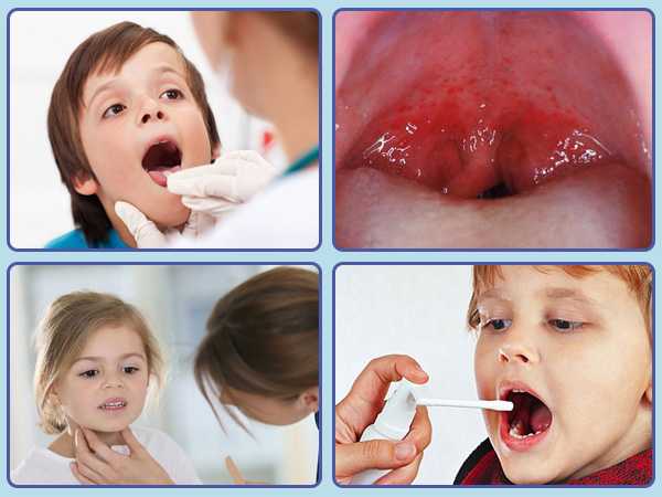 Лечение тонзиллита у детей - симптомы острой и хронической форм у ребенка 2-3 и старше 4-5 лет, профилактика (+фото)