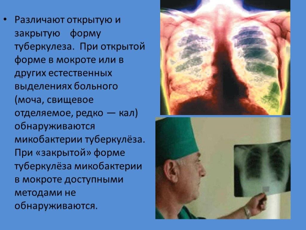 Закрытая форма туберкулеза можно ли заразиться, ответы врачей, консультация
