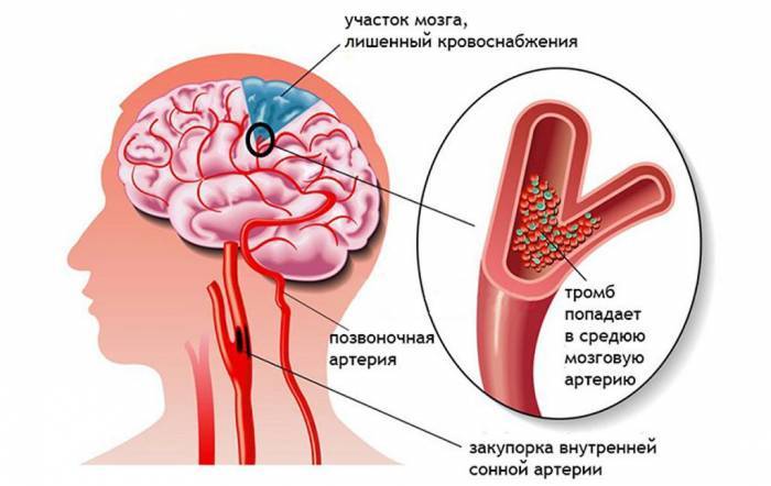 Как лечить атеросклероз сосудов головного мозга: симптомы