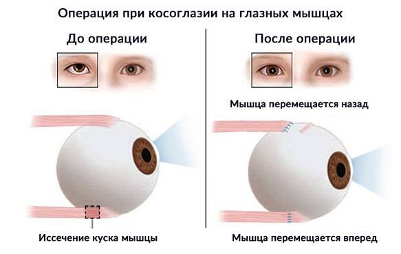 Амблиопия | мнтк «микрохирургия глаза» им. акад. с.н. федорова