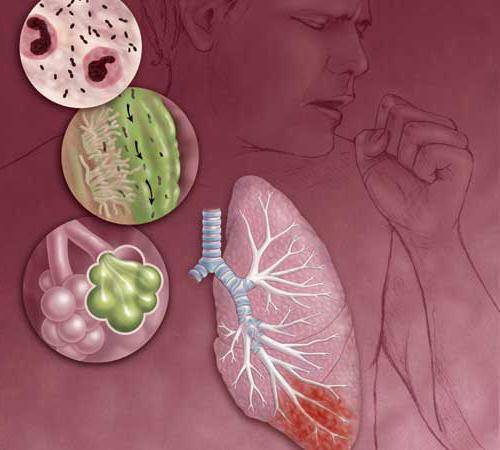 Пневмония: симптомы у взрослых без температуры
