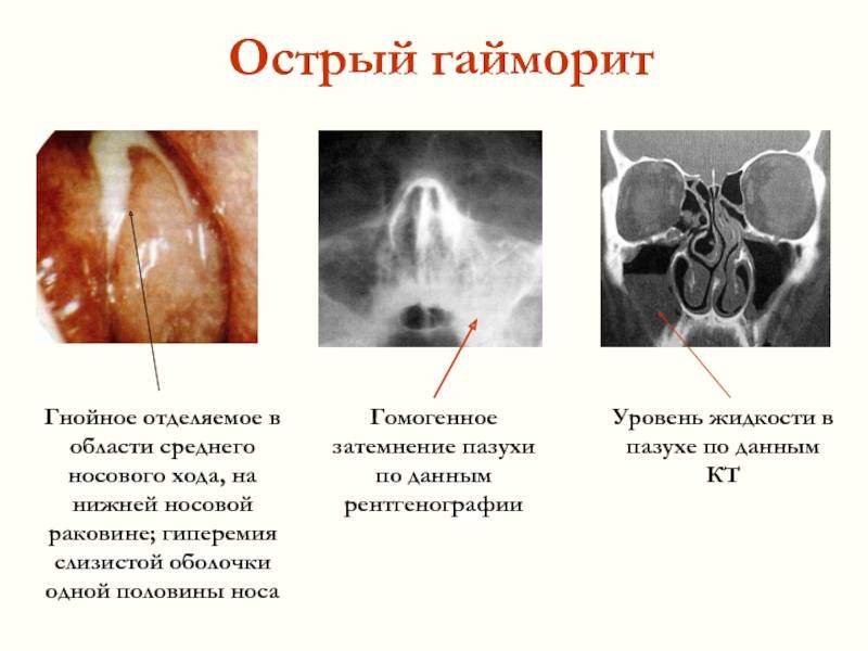 Хроническое заболевание полости носа характеризующееся атрофией слизистой - wikilechenie.ru