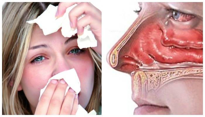 Сухая заложенность носа: сухость и закладывает уши без насморка, лечение