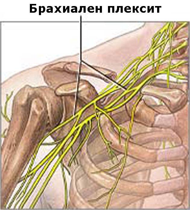 Невропатия плечевого сплетения