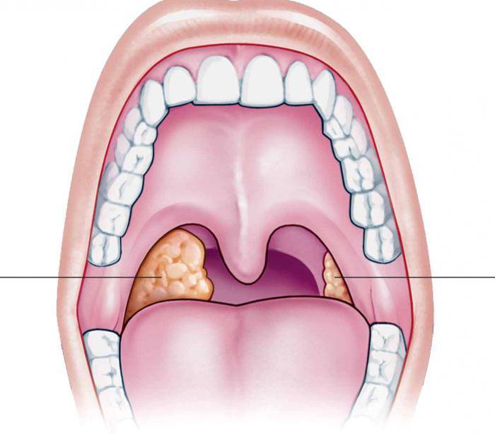 Удаление миндалин при хроническом тонзиллите у взрослых: как выглядит горло после удаления