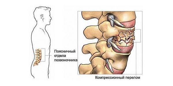 Компрессионный перелом грудного отдела позвоночника (позвонка): чем грозит, симптомы, признаки, лечение, последствия