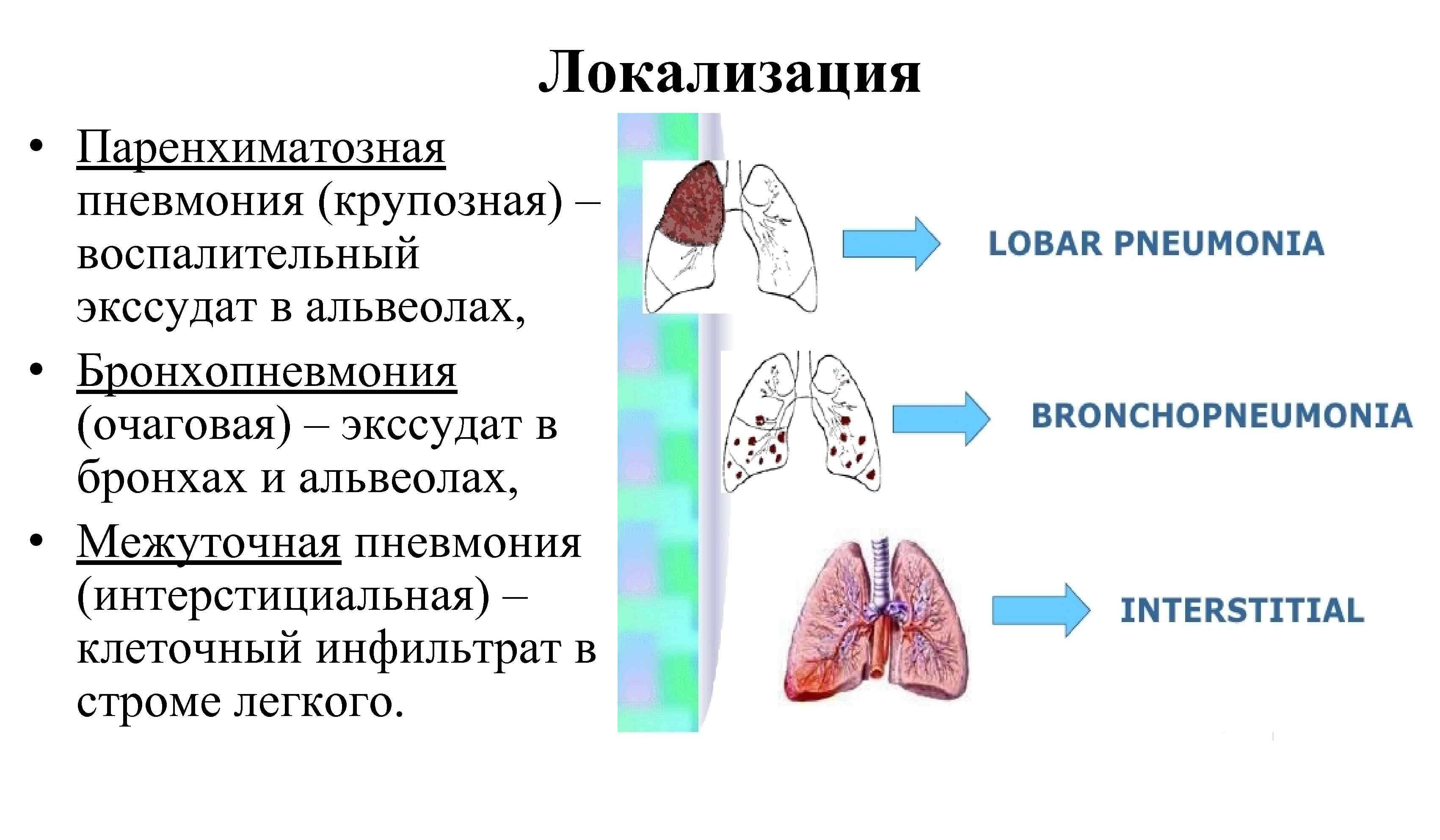 Крупозная пневмония: стадии, осложнения, лечение