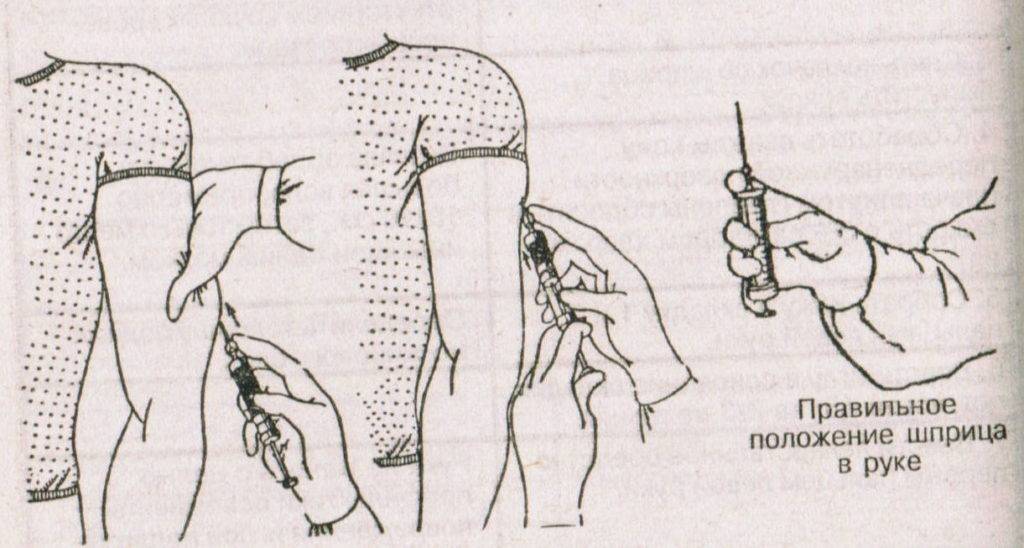 Как сделать укол в бедро самому себе: ставить внутримышечно в ногу, поставить правильно, куда колоть инъекцию, техника выполнения взрослому, мнение врачей, складки как у шарпея, подкожный в мышцу, почему болит после
