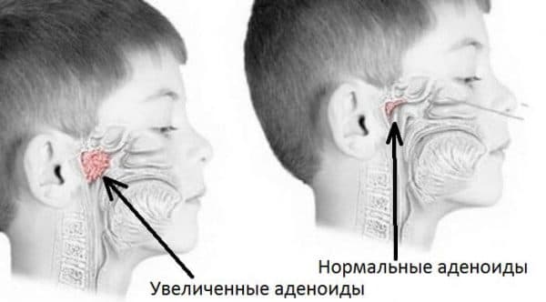 Гнойный аденоидит у детей: симптомы, лечение pulmono.ru
гнойный аденоидит у детей: симптомы, лечение