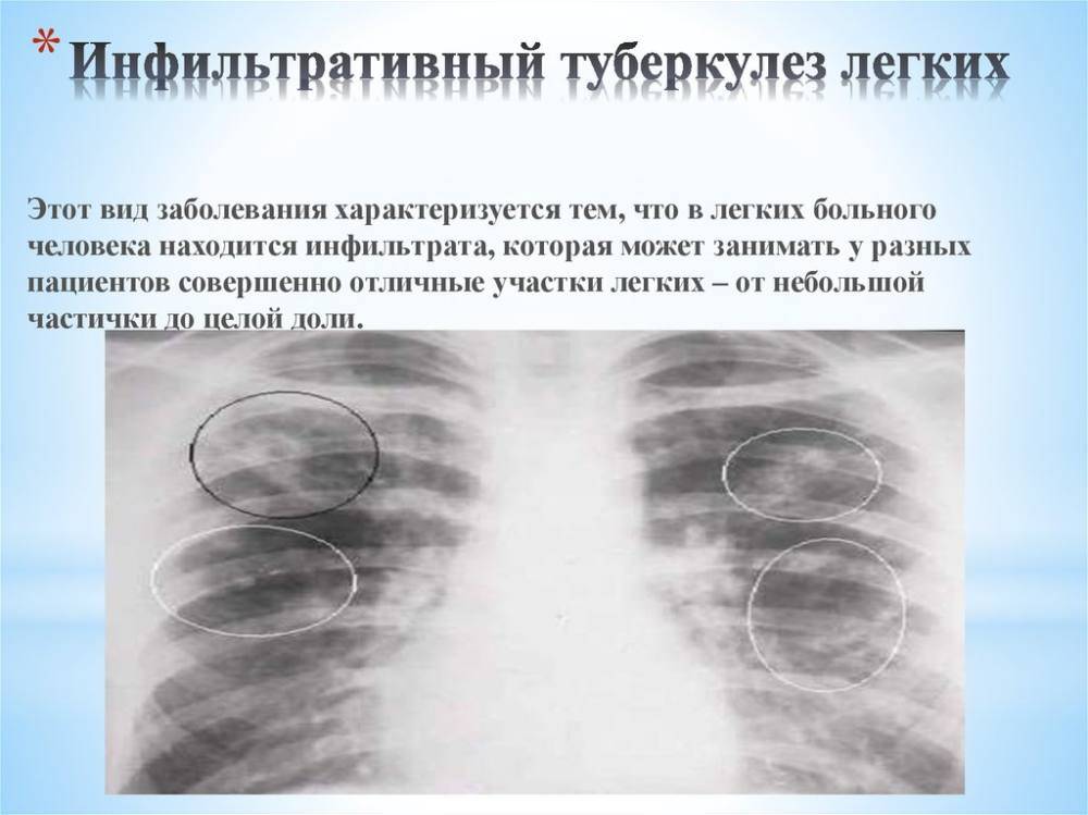Очаговый туберкулез легких
