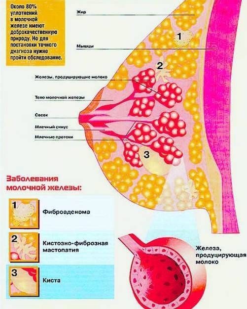 Диффузная фиброзно-кистозная мастопатия молочных желез: лечение народными средствами, лекарствами и диетой