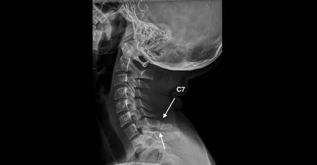Перелом позвоночника (спины): симптомы, признаки, виды переломов, классификация, лечение, последствия