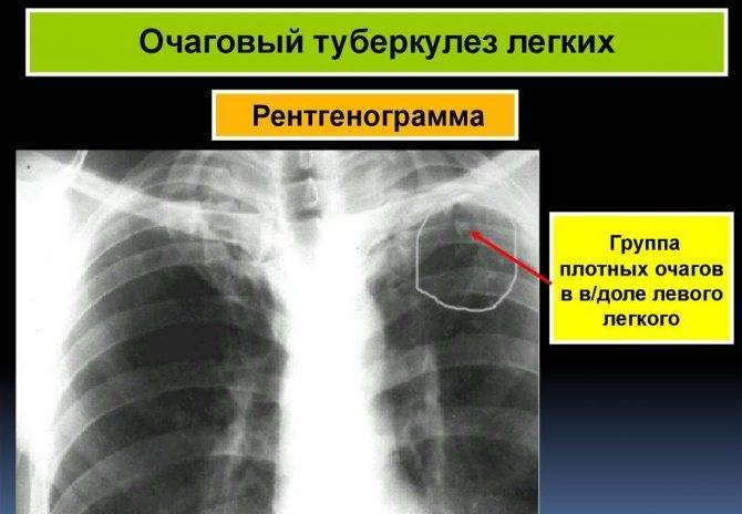 Очаговый туберкулез легких: заразен или нет, лечение и что это такое