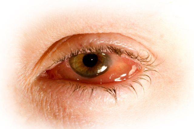 11 последствий недолеченного гайморита и заразен ли он для окружающих; можно ли заразиться от больного человека; чем опасен гайморит и его осложнения, если не лечить: рак гайморовой пазухи, фронтит, осложнения на глаза - конъюктивит, осложнения на уши