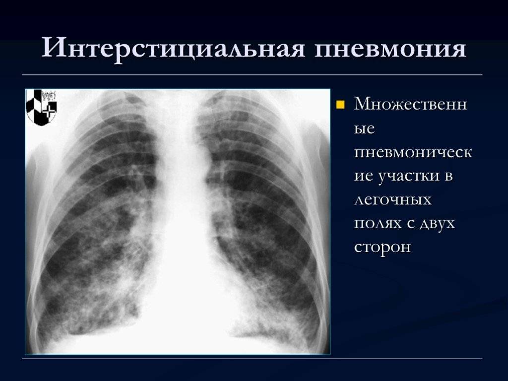 Крупозная пневмония у взрослых и детей: симптомы и лечение | pnevmonya.ru