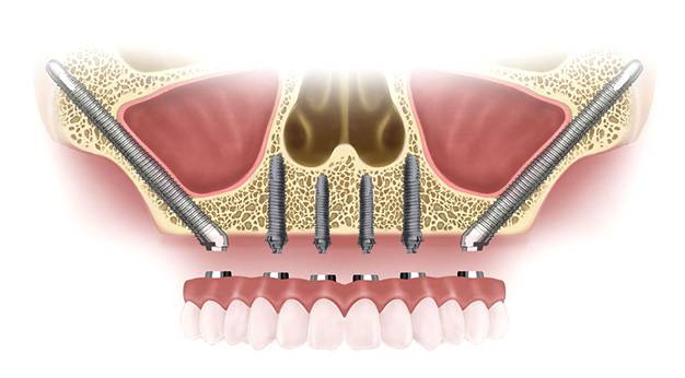 Базальная имплантация – скажи «нет» синус-лифтингу! - популярные статьи - стоматология