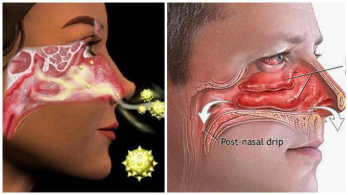 Почему заложен нос без соплей – лечение у взрослых заложенности