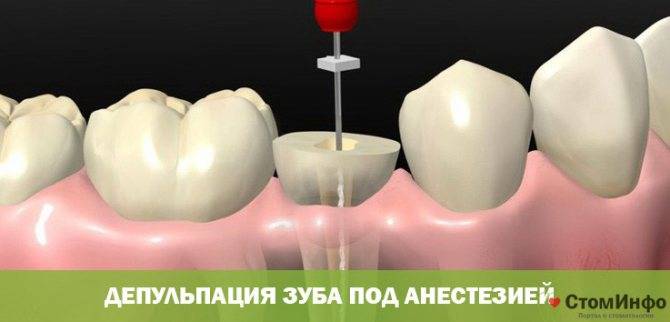 Когда проводится депульпирование зуба перед протезированием - цена процедуры, что она из себя представляет