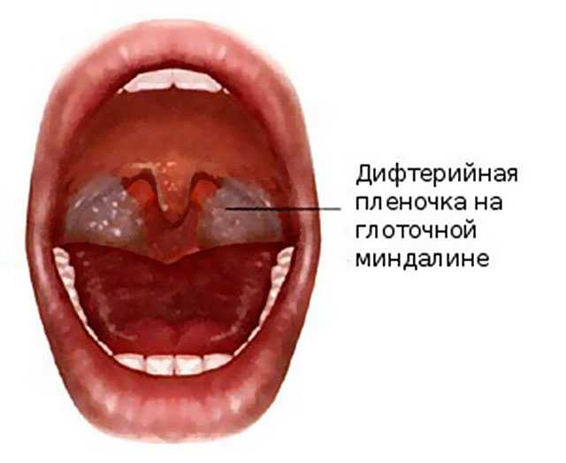 Ангина стафилококк или стрептококк - болезни горла